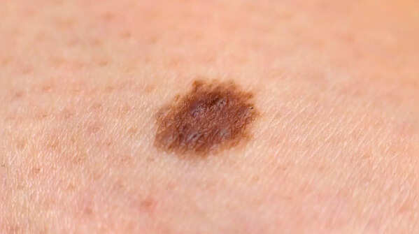 Check for pigment spreading from a mole