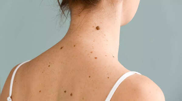 Be aware of new moles and unusual skin growths