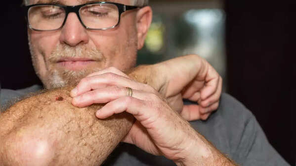 Understanding the first signs of skin cancer