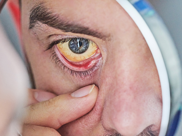 Jaundice: Yellowing of eyes and skin