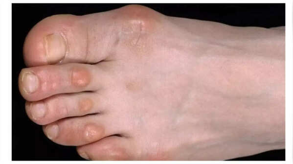 Painful lumps as possible indicators of heart problems