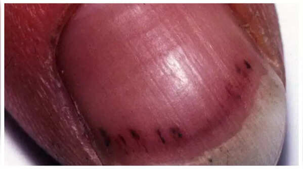 Red or purple lines under nails indicating potential heart infection