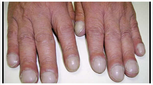 Changes in nail shape suggesting underlying health issues