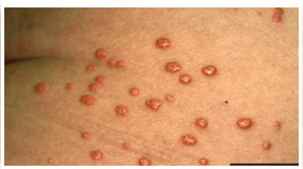 Yellowish-orange bumps signaling high cholesterol and heart risk