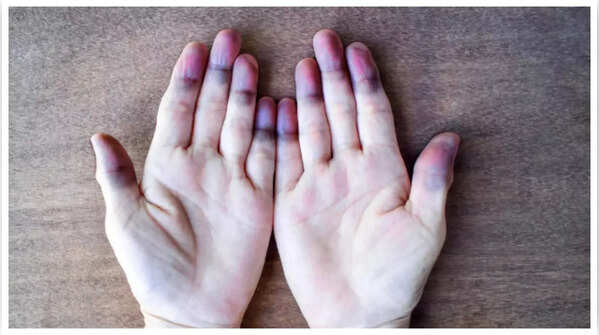 Blue or purple discoloration indicating potential heart problems