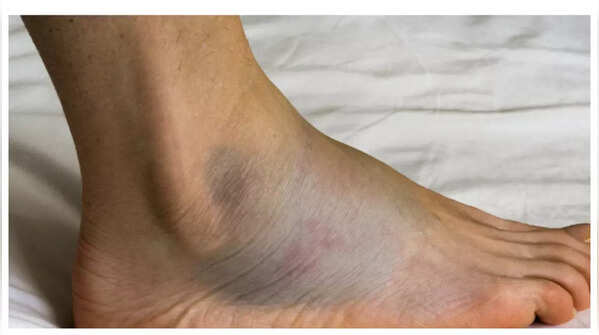 Swollen feet and ankles as a sign of heart condition