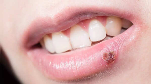 A persistent sore that doesn't heal with time