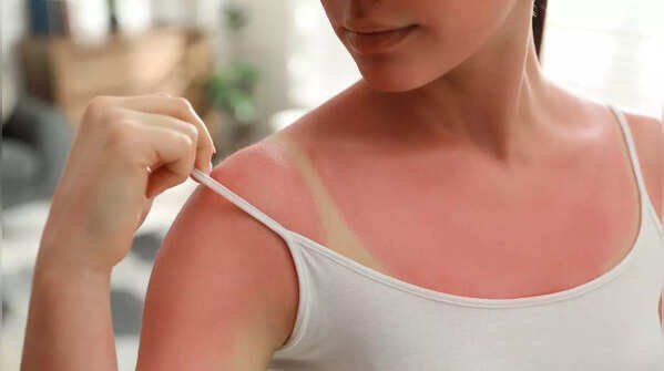 What causes skin cancer?